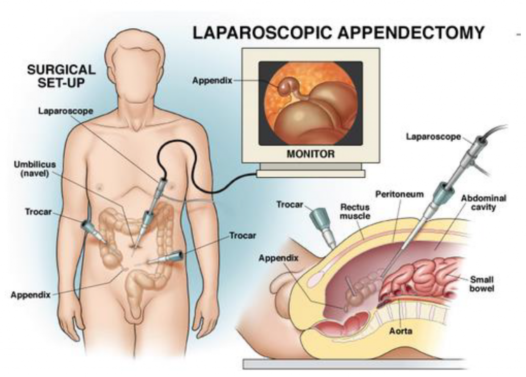 human-appendix-anatomy-location-and-function-of-appendix